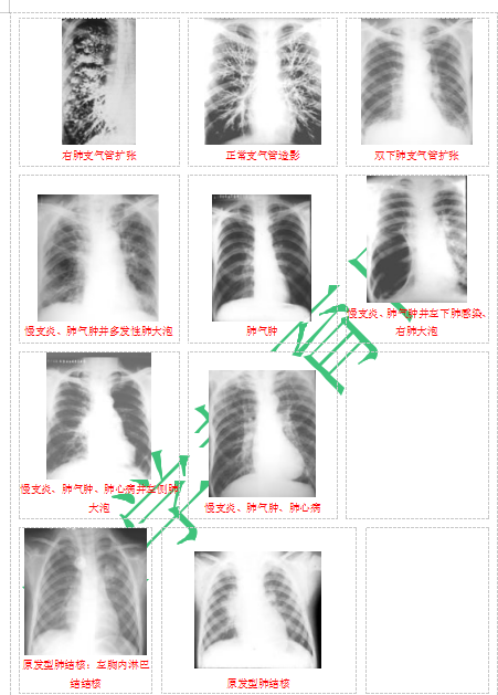 快收藏！臨床助理醫(yī)師實(shí)踐技能62個(gè)胸片（圖片診斷）